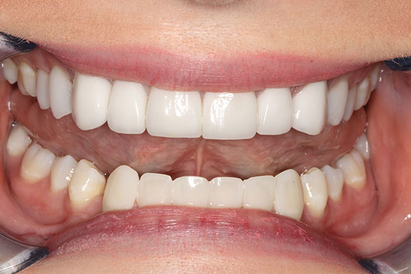 realigned and whitened teeth after a dental procedure from Lakewinds Dental Centre