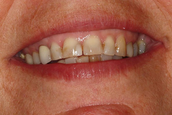 discolored teeth before a dental procedure from Lakewinds Dental Centre