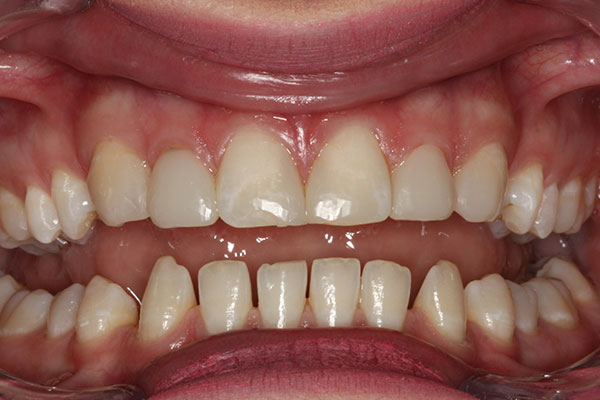 misaligned teeth before a dental procedure from Lakewinds Dental Centre