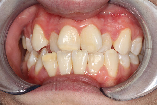 misaligned teeth before a dental procedure from Lakewinds Dental Centre