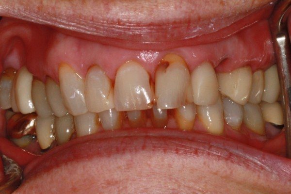 colored teeth before a dental procedure from Lakewinds Dental Centre