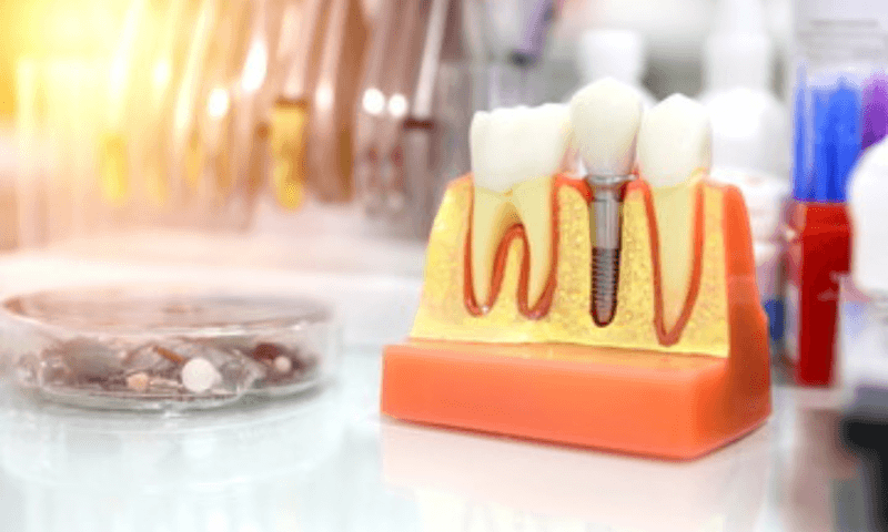 Know about dental implants
