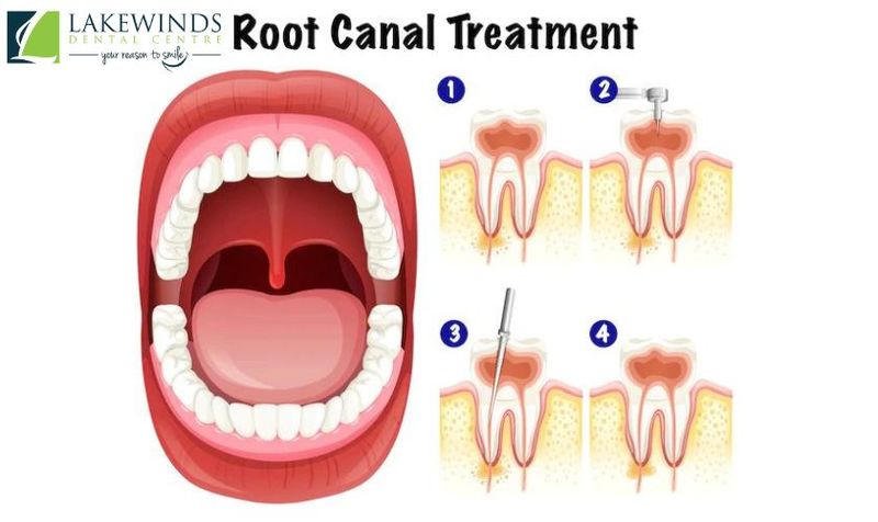 5 Things You Must Know About Root Canals