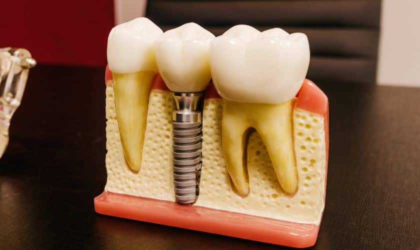 dental implants in Ludington