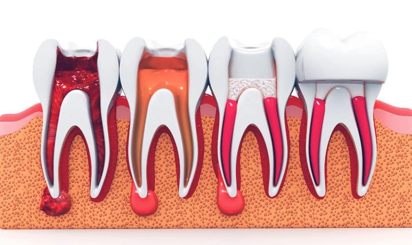 Root Canal Therapy Ludington