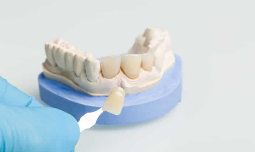 Procedure for Porcelain-Veneers