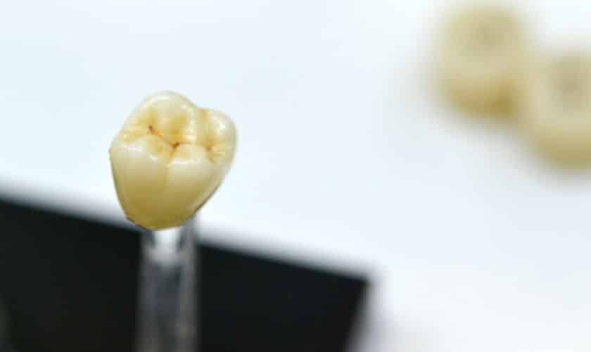 Porcelain Dental Crowns