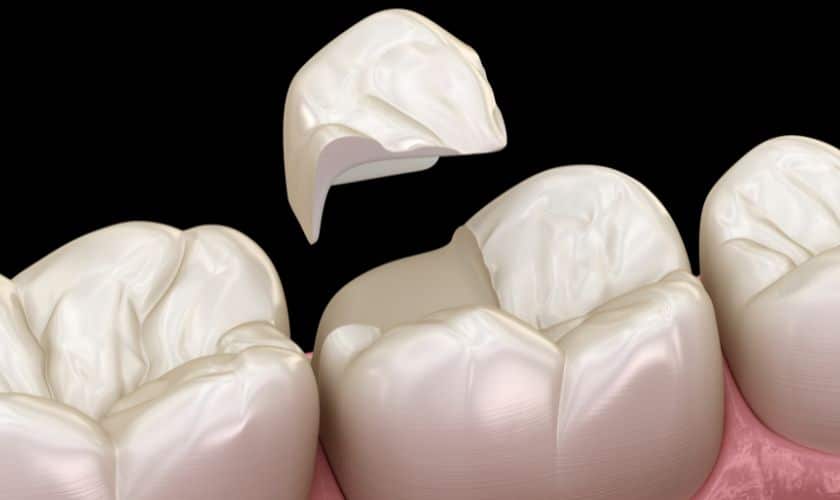cracked tooth