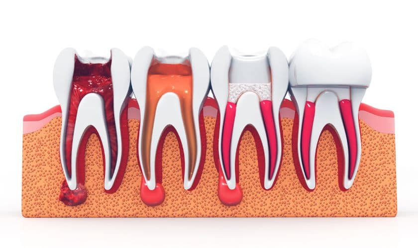 root canal therapy