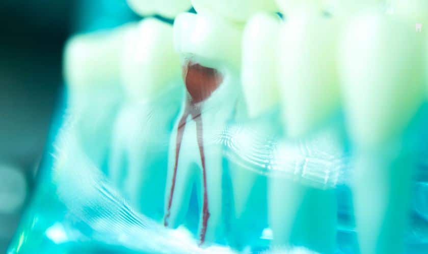 root canal therapy process