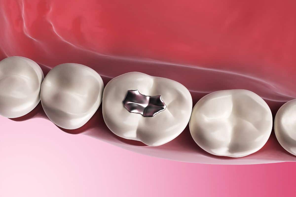 dental fillings