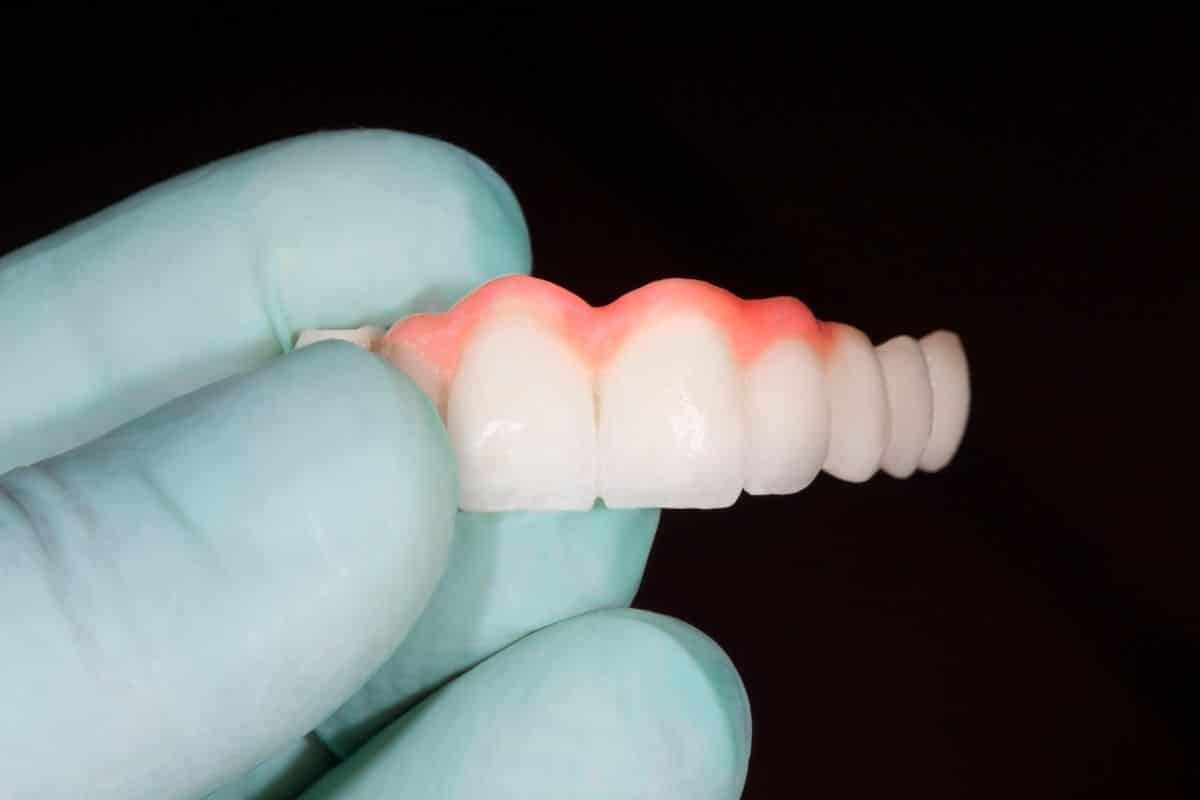 Tips for Maintaining Your Dental Bridge