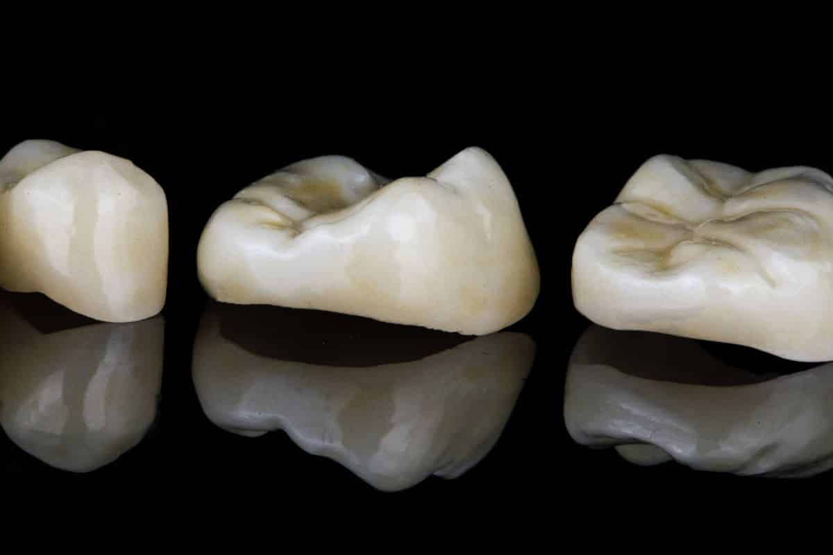 Inlays & Onlays vs. Crowns