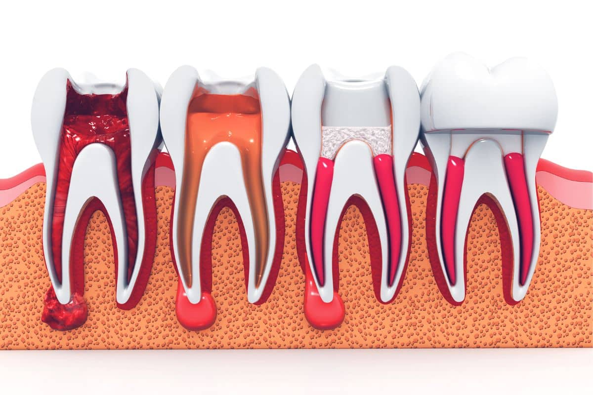 How Root Canal Therapy Saves Your Natural Tooth