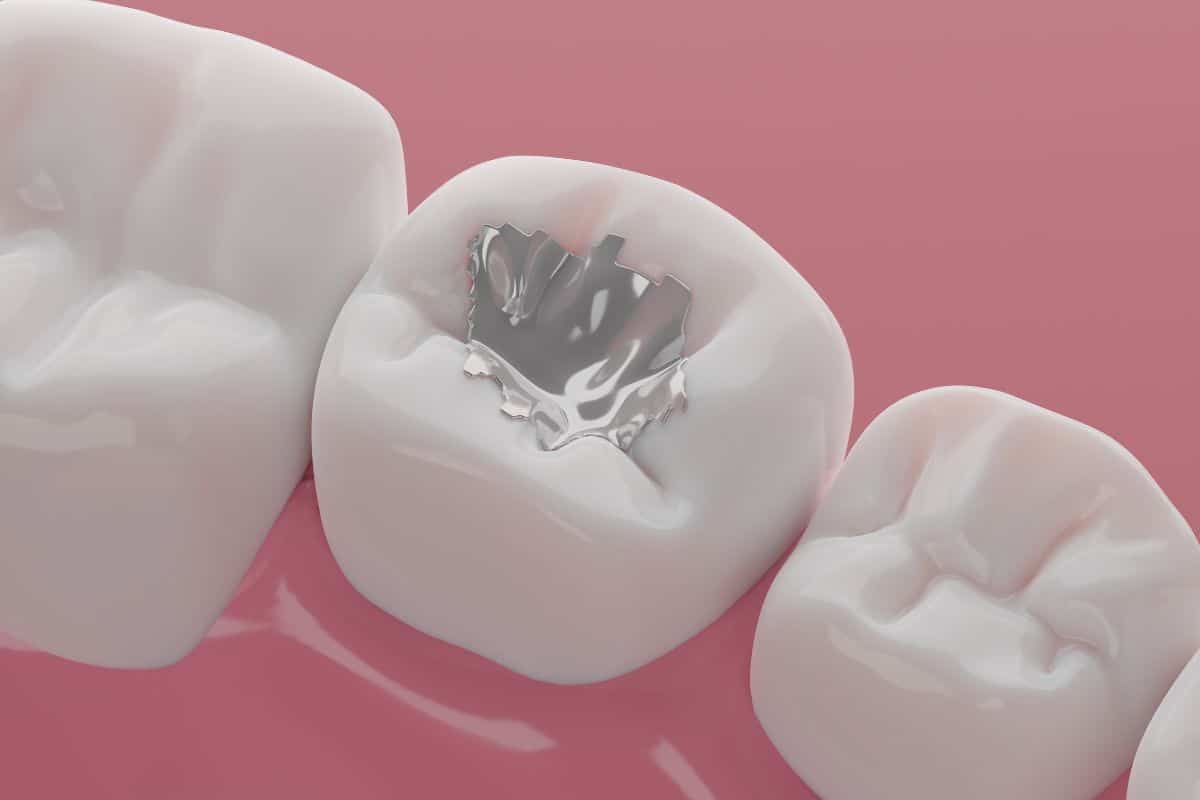 Tips for Maintaining Dental Fillings