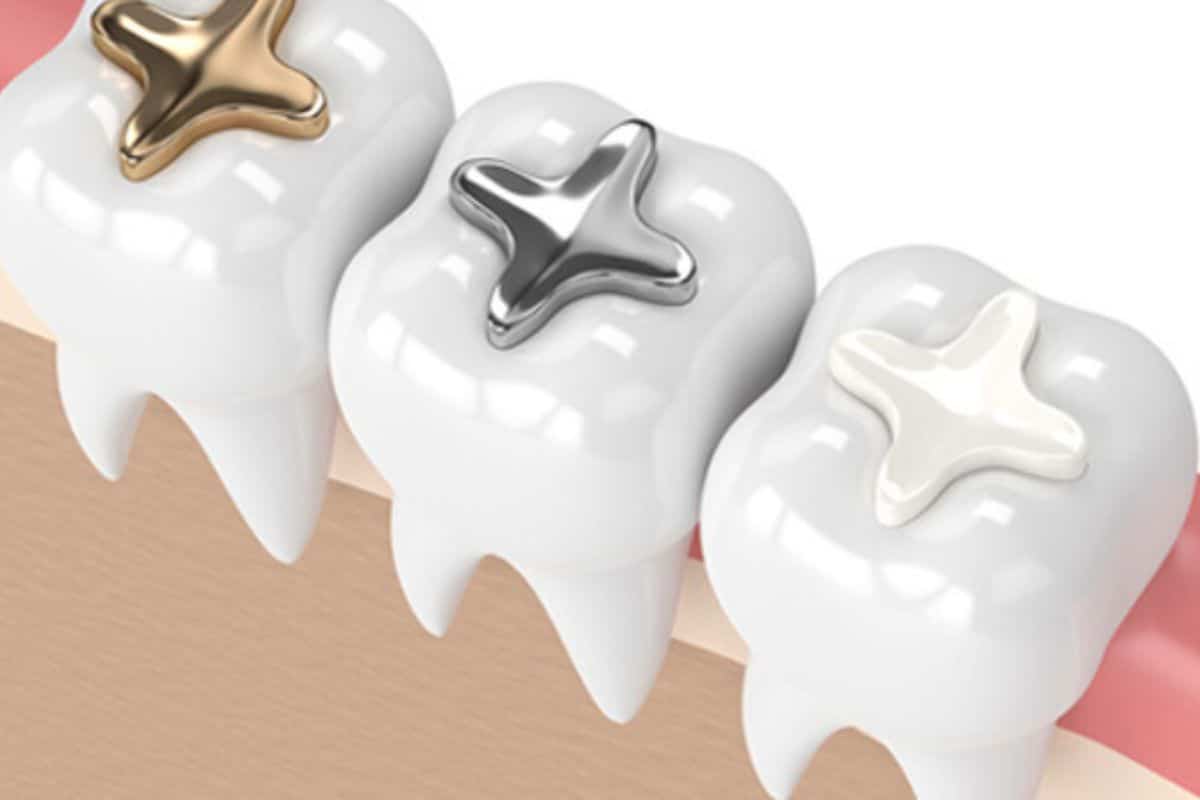 composite fillings vs silver fillings