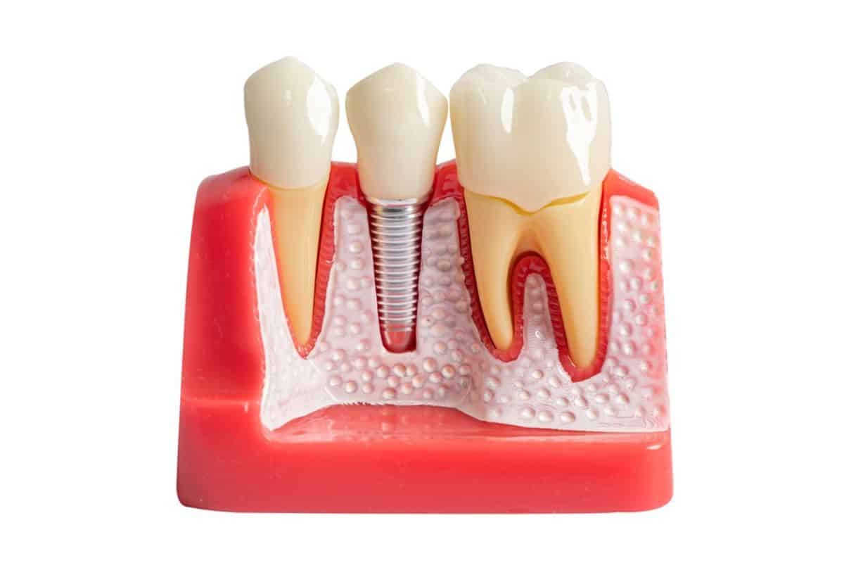 Dental Implants Ludington