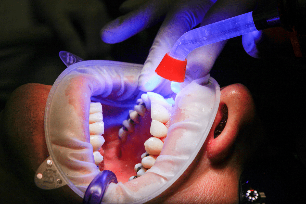 How to Care for Your Composite Fillings