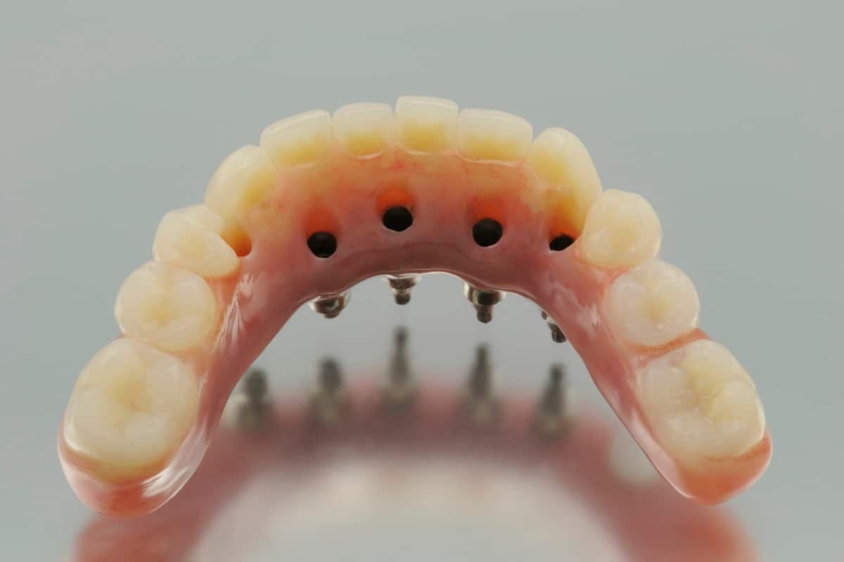 Benefits of Dental Implants Over Traditional Bridges or Dentures