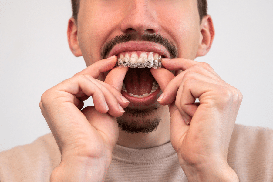 Invisalign Aligner Gaps