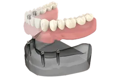 All-On-4 Dental Implants