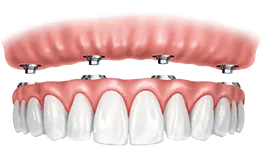 Implant Supported Denture