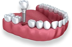 Single Implant
